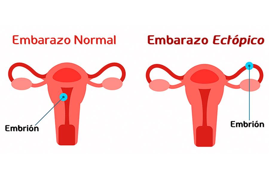 embarazo ectopico que es
